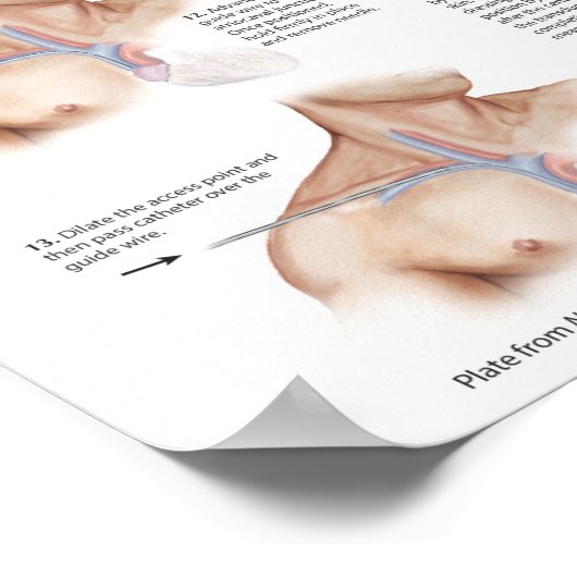 Netter Chart: Central Venous Catheterization Poster (Hoek)