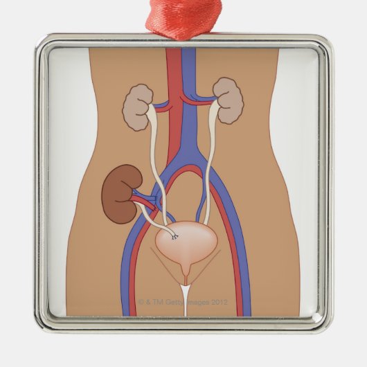 Niertransplantatie Metalen Ornament (Voorkant)