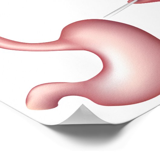 Nissen Fundoplicatimaag Poster voor chirurgie (Hoek)