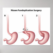 Nissen Fundoplicatimaag Poster voor chirurgie (Voorkant)