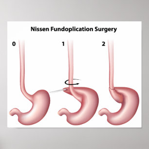 Nissen Fundoplicatimaag Poster voor chirurgie