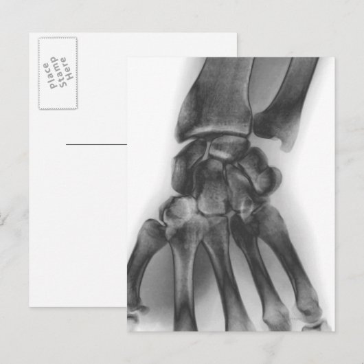 Normale pols, röntgenstraal briefkaart (Voorkant / Achterkant)
