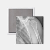 Normale schouder. Röntgenfoto van de gezonde linke Magneet (Voorkant / Achterkant)