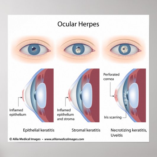Oculaire herpes-infectie, met de vermelding diagra poster (Voorkant)
