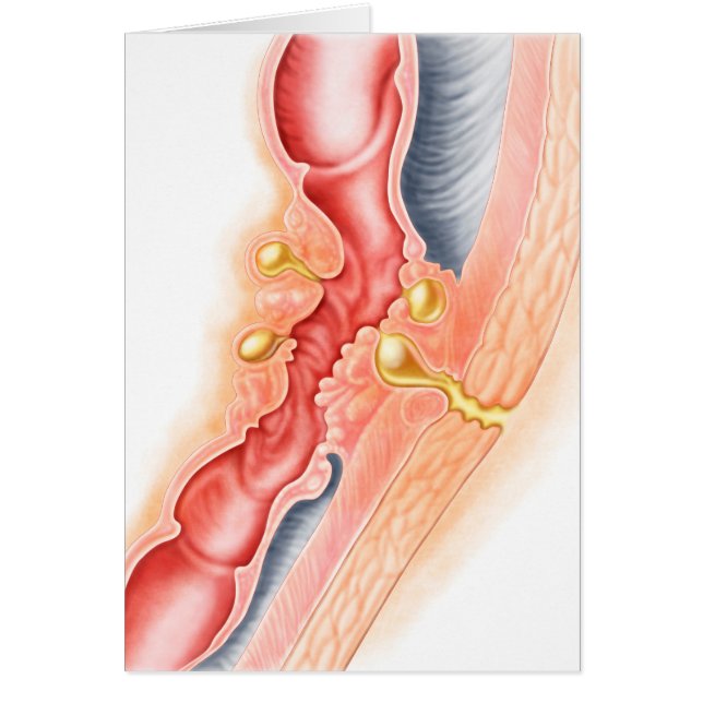 Ontwikkeling van fistels (Voorkant)