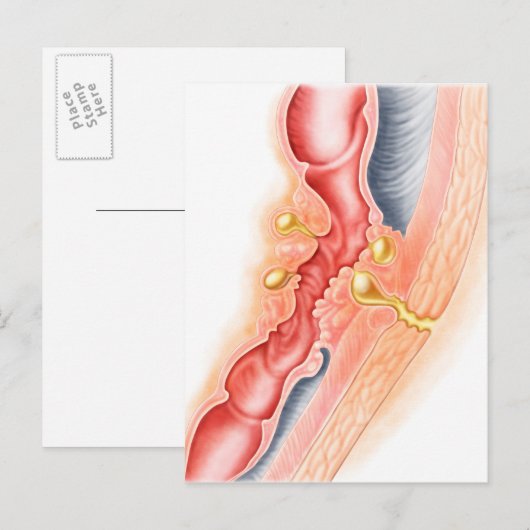 Ontwikkeling van fistels briefkaart (Voorkant / Achterkant)