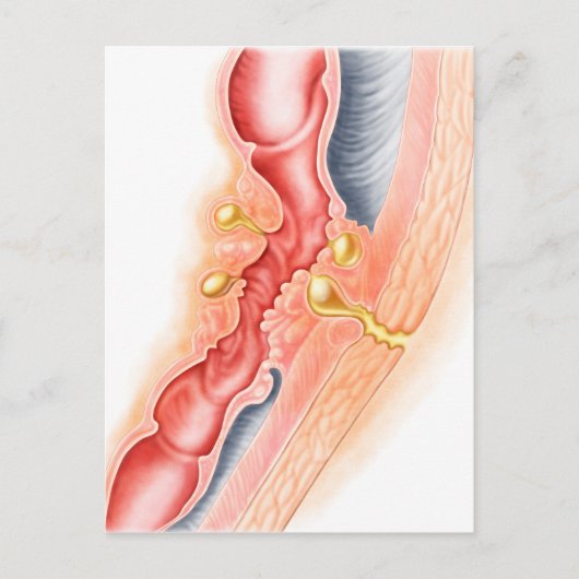 Ontwikkeling van fistels briefkaart (Voorkant)
