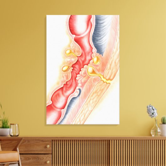 Ontwikkeling van fistels canvas afdruk (Insitu (Woonkamer))