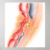 Ontwikkeling van fistels poster (Voorkant)
