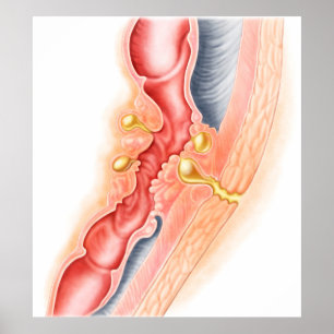 Ontwikkeling van fistels poster