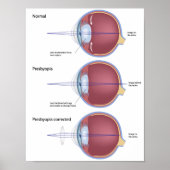 Oogdefect presbyopia Poster (Voorkant)