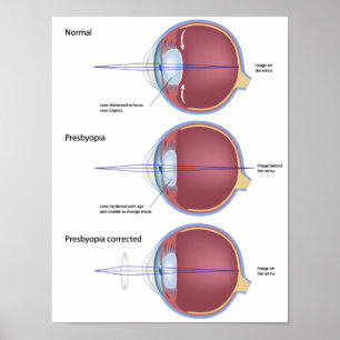 Oogdefect presbyopia Poster