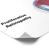 Oogziekte Diabetische retinopathie Poster (Hoek)