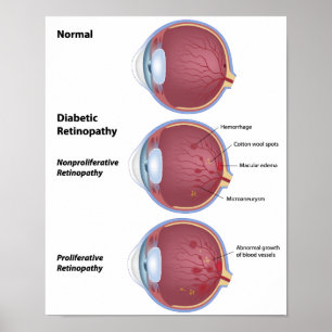 Oogziekte Diabetische retinopathie Poster