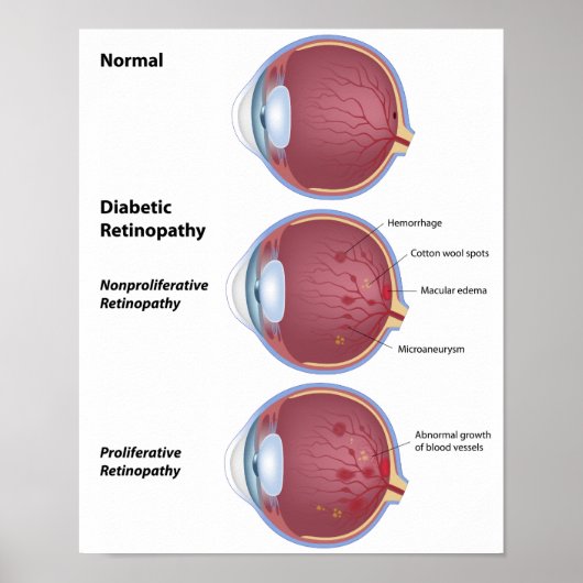 Oogziekte Diabetische retinopathie Poster (Voorkant)