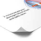 Oogziekte Glaucoom Poster (Hoek)