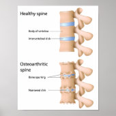 Osteoartritis van de wervelkolom Poster (Voorkant)