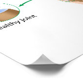 Osteoartritis van het hand Poster (Hoek)