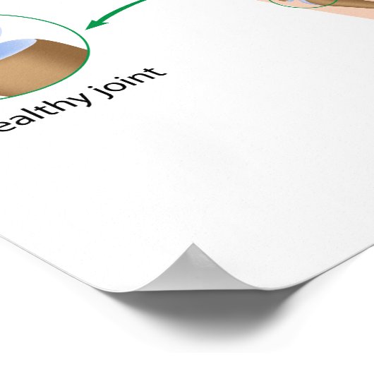 Osteoartritis van het hand Poster (Hoek)