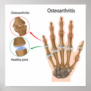 Osteoartritis van het hand Poster