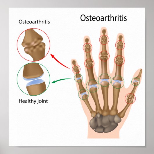 Osteoartritis van het hand Poster (Voorkant)