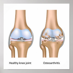 Osteoartritis van kniegewrichten Poster