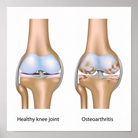 Osteoartritis van kniegewrichten Poster (Voorkant)