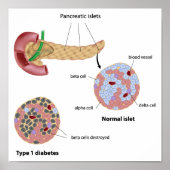 Pancreaseiland en Poster van diabetes (Voorkant)