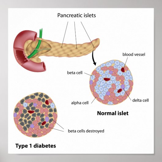 Pancreaseiland en Poster van diabetes (Voorkant)