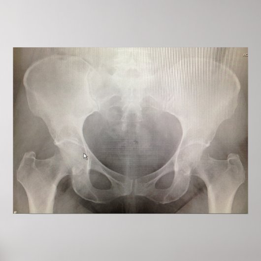 Pelvis X-ray Poster (Voorkant)