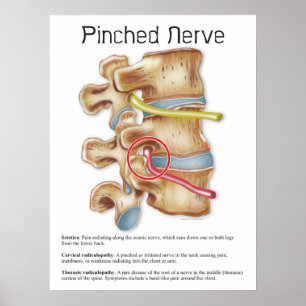 Pinched Nerve Physical Therapy Chiropractic Chart Poster