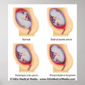 Placenta previa poster (Voorkant)