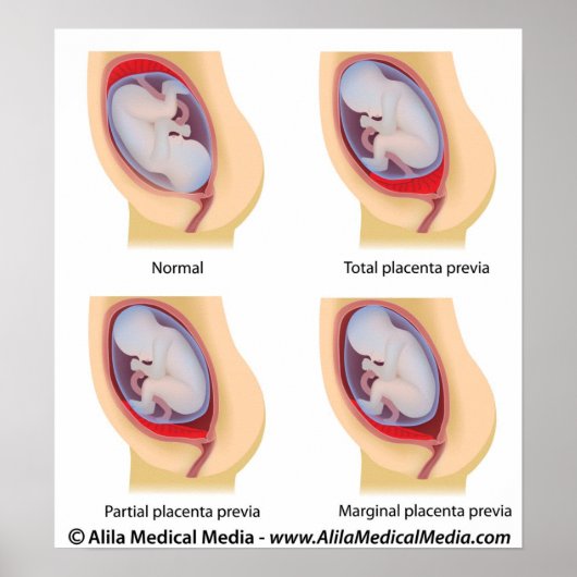 Placenta previa poster (Voorkant)