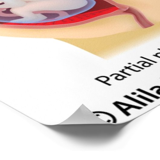 Placenta previa poster (Hoek)