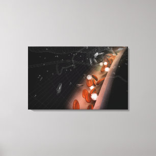 Plaque in de slagaders canvas afdruk