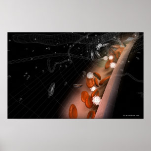 Plaque in de slagaders poster