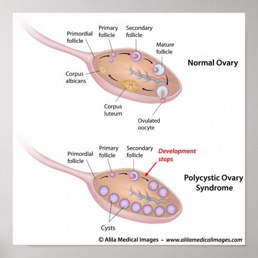 Polycysteus ovariumsyndroom, met een schema. poster (Voorkant)