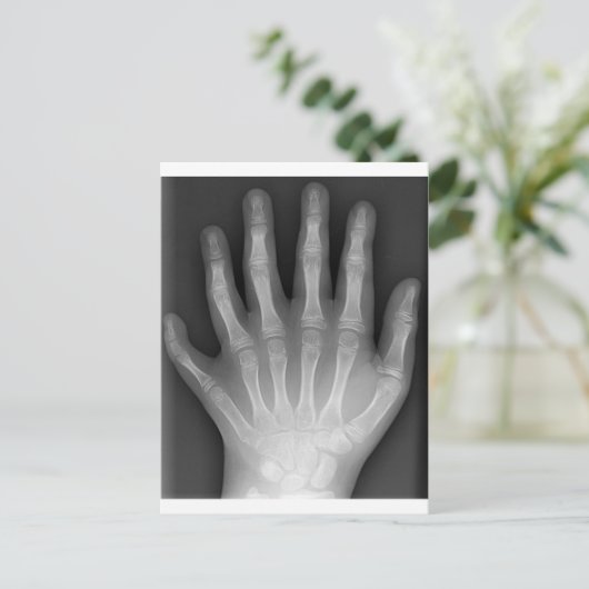 Polydactyly, Six Fingered Hand, X-Ray, zeldzaamhei Briefkaart (Staand voorkant)