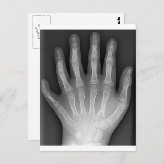 Polydactyly, Six Fingered Hand, X-Ray, zeldzaamhei Briefkaart (Voorkant / Achterkant)
