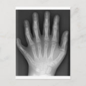 Polydactyly, Six Fingered Hand, X-Ray, zeldzaamhei Briefkaart (Voorkant)