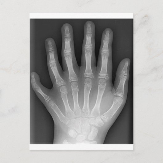 Polydactyly, Six Fingered Hand, X-Ray, zeldzaamhei Briefkaart (Voorkant)