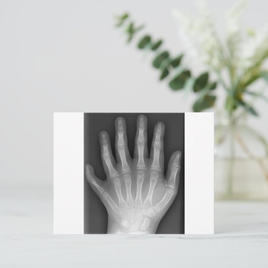 Polydactyly, Six Fingered Hand, X-Ray, zeldzaamhei Briefkaart (Staand voorkant)