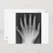 Polydactyly, Six Fingered Hand, X-Ray, zeldzaamhei Briefkaart (Voorkant / Achterkant)