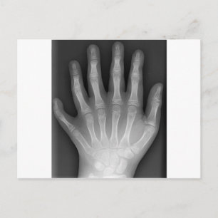 Polydactyly, Six Fingered Hand, X-Ray, zeldzaamhei Briefkaart