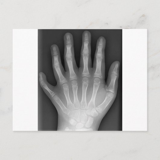 Polydactyly, Six Fingered Hand, X-Ray, zeldzaamhei Briefkaart (Voorkant)