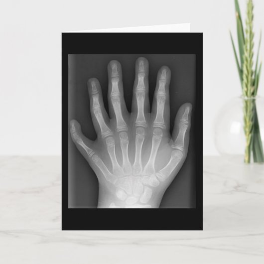 Polydactyly, Six Fingered Hand, X-Ray, zeldzaamhei Kaart (Voorkant)