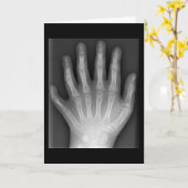 Polydactyly, Six Fingered Hand, X-Ray, zeldzaamhei Kaart (Gele Bloem)