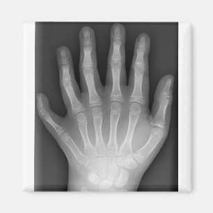 Polydactyly, Six Fingered Hand, X-Ray, zeldzaamhei Magneet