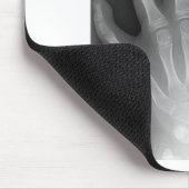 Polydactyly, Six Fingered Hand, X-Ray, zeldzaamhei Muismat (Hoek)