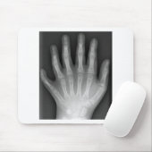 Polydactyly, Six Fingered Hand, X-Ray, zeldzaamhei Muismat (Met muis)